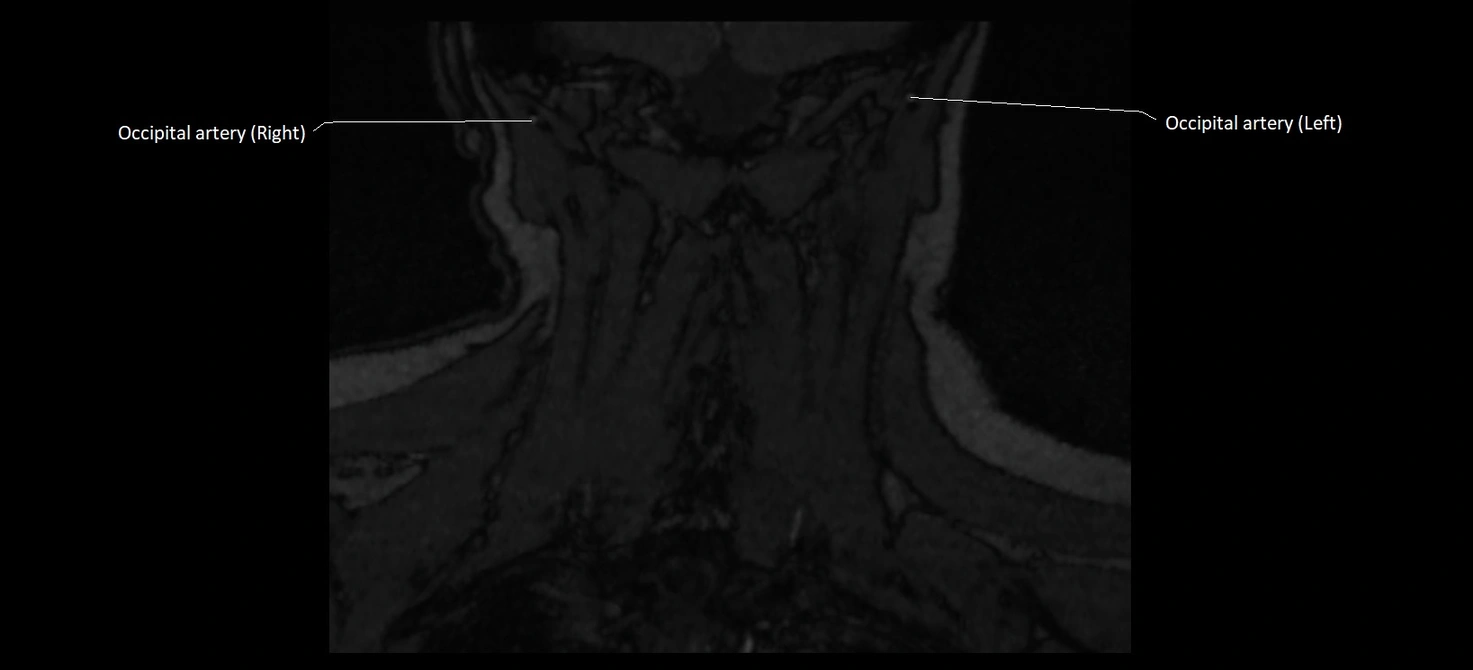 MRA carotid artery anatomy cross sectional 3T coronal image 20.webp